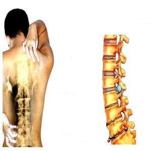 Fase di osteocondrosi