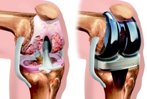 Prima e dopo l'endoprotetica dell'articolazione del ginocchio con artrosi