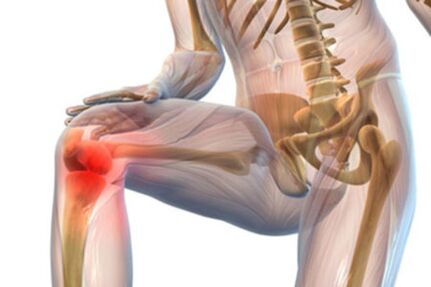 Dolore all'articolazione del ginocchio con artrosi