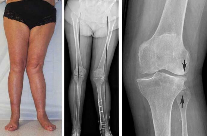 artrosi avanzata dell'articolazione del ginocchio