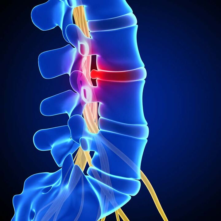 Protrusione del disco intervertebrale nel canale spinale derivante da osteocondrosi della colonna lombare