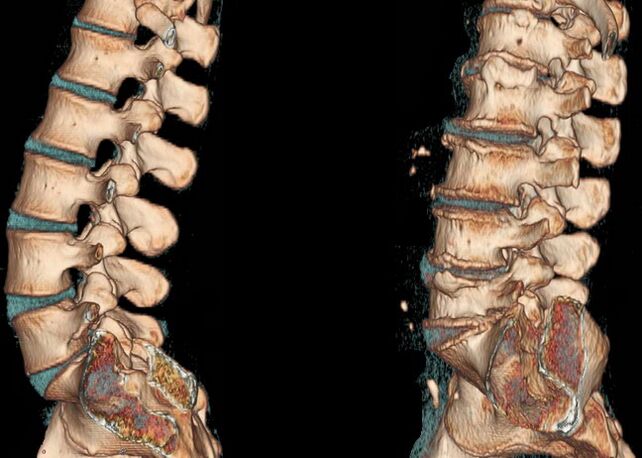 Osteocondrosi della colonna vertebrale su una TAC