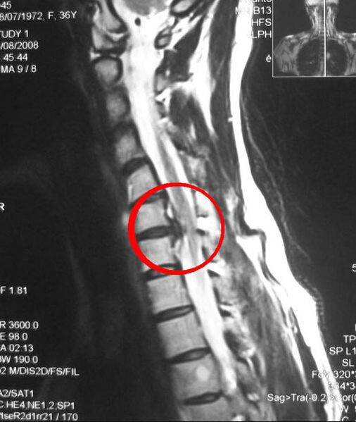 Sintomi dell'osteocondrosi toracica su una radiografia